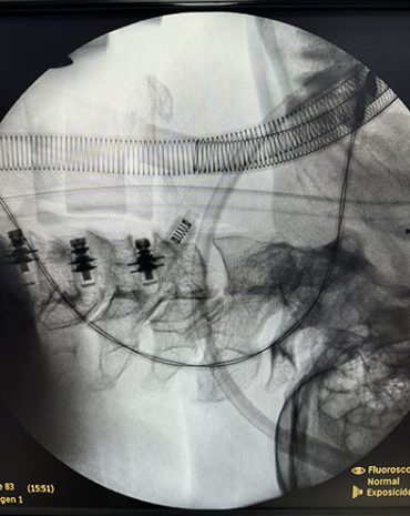 06-medulaespinal-cirugia